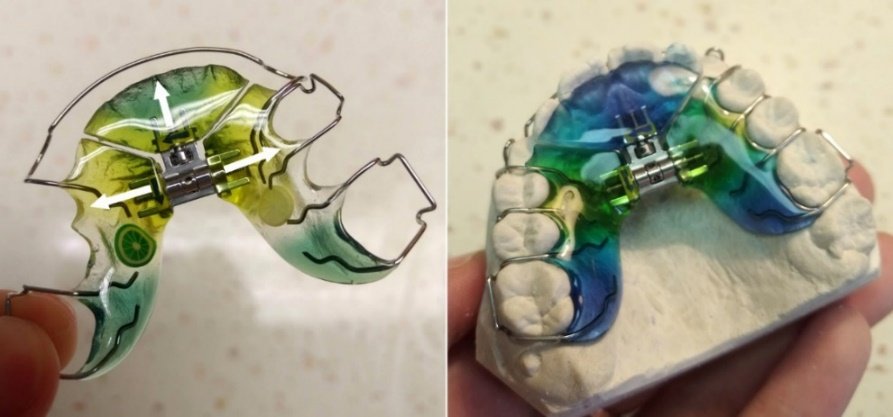 snimaci-ortodonticke-aparaty